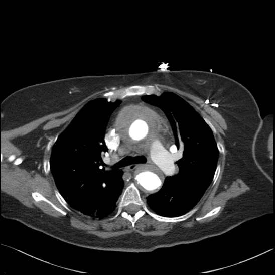 Aortic intramural hematoma with dissection and intramural blood pool (Radiopaedia 77373-89491 B 49).jpg