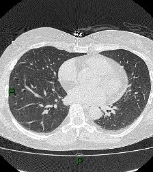 File:Aortic valve endocarditis (Radiopaedia 87209-103485 Axial lung window 61).jpg