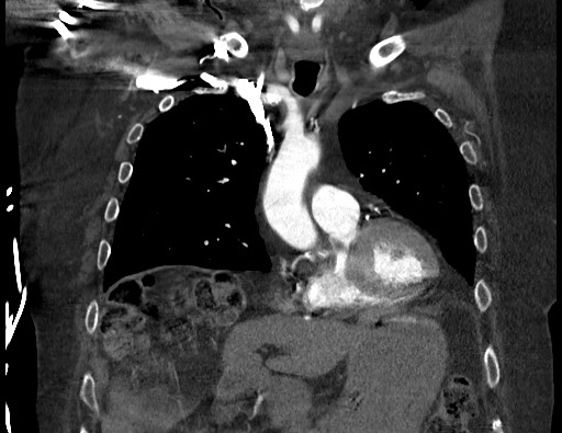 Aortoesophageal fistula with endovascular repair (Radiopaedia 73781-84592 Coronal C+ CTPA 38).jpg