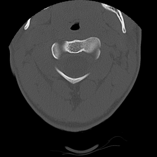 Apical pneumothorax on cervical spine CT (Radiopaedia 45343-49368 Axial bone window 18).jpg