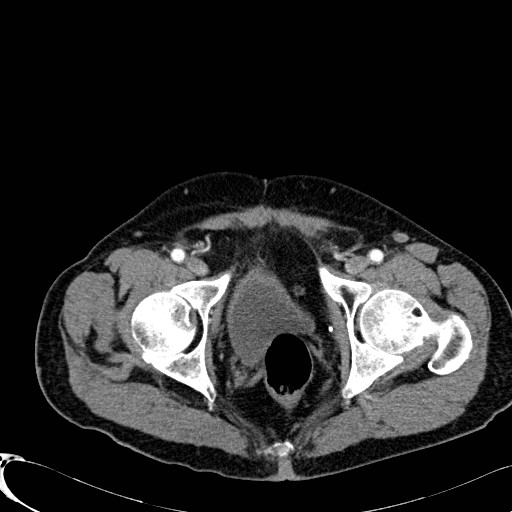 Appendiceal adenocarcinoma complicated by retroperitoneal abscess (Radiopaedia 58007-65039 B 135).jpg
