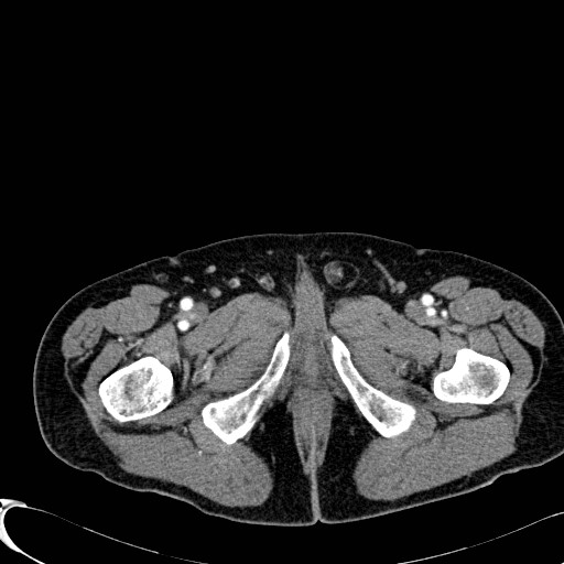File:Appendiceal adenocarcinoma complicated by retroperitoneal abscess (Radiopaedia 58007-65039 B 155).jpg