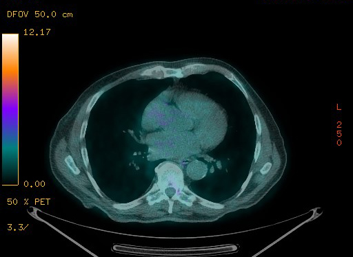 Appendiceal adenocarcinoma complicated by retroperitoneal abscess (Radiopaedia 58007-65041 Axial PET-CT 76).jpg