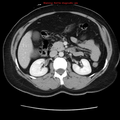 Appendiceal mucinous cystadenoma (Radiopaedia 8263-9111 Axial liver window 34).jpg