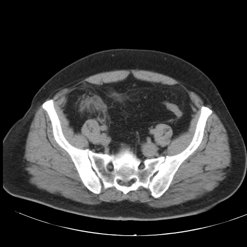 Appendicitis and giant appendicolith (Radiopaedia 80251-93588 Axial non-contrast 45).jpg