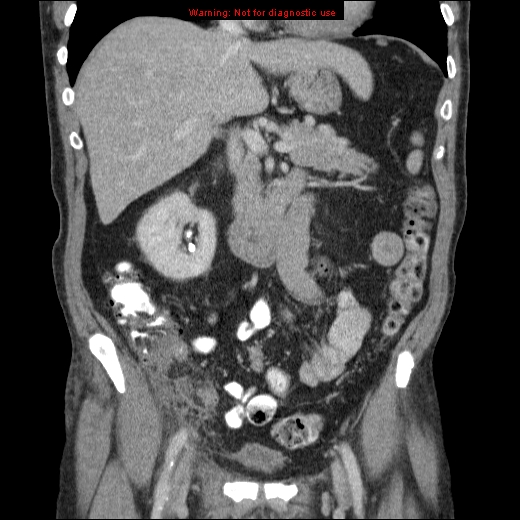 File:Appendicitis mass in inguinal hernia (Radiopaedia 26858-27029 B 30).jpg