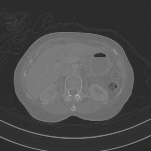 April fools' 2019- calcified peritoneal arachnoidosis (Radiopaedia 67273-76636 Axial bone window 10).png