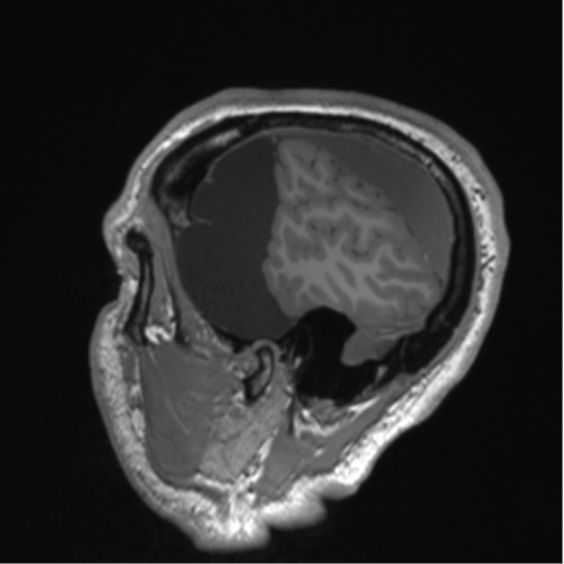 Arachnoid cyst with subdural hematoma (Radiopaedia 85892-101743 Sagittal T1 19).png