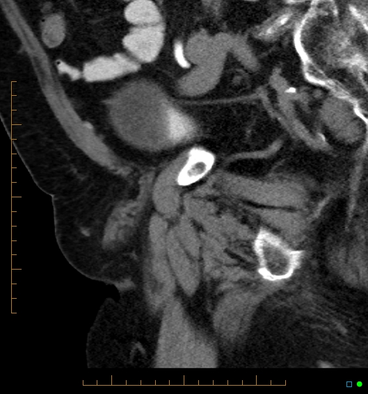 File:Artificial urethral sphincter (Radiopaedia 46937-51464 Sagittal C+ delayed 12).jpg