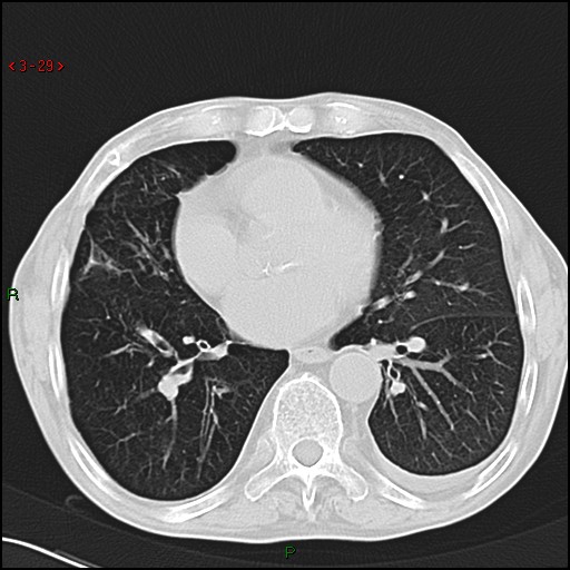 File:Aspergilloma (Radiopaedia 14842-14787 Axial lung window 29).jpg