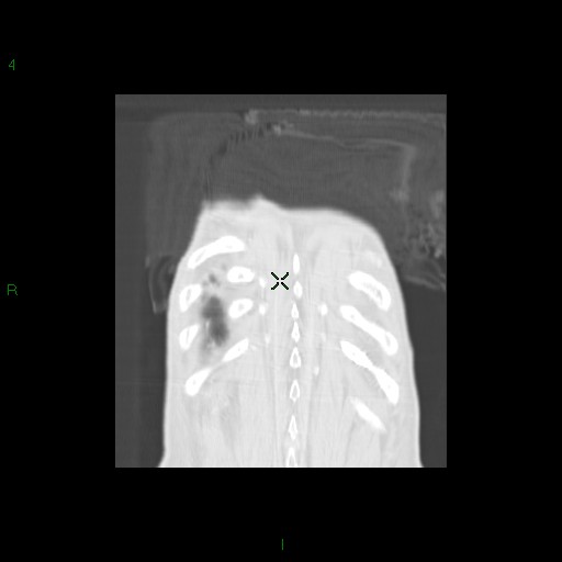 File:Aspergilloma (Radiopaedia 14842-14787 Coronal lung window 36).jpg