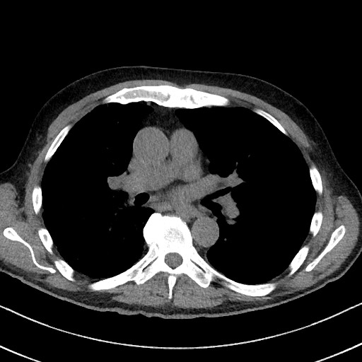 Aspergilloma on background pulmonary fibrosis (Radiopaedia 60942-68757 Axial non-contrast 29).jpg
