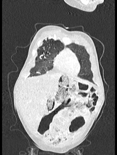 Asplenia syndrome (Radiopaedia 73083-83792 Coronal lung window 15).jpg