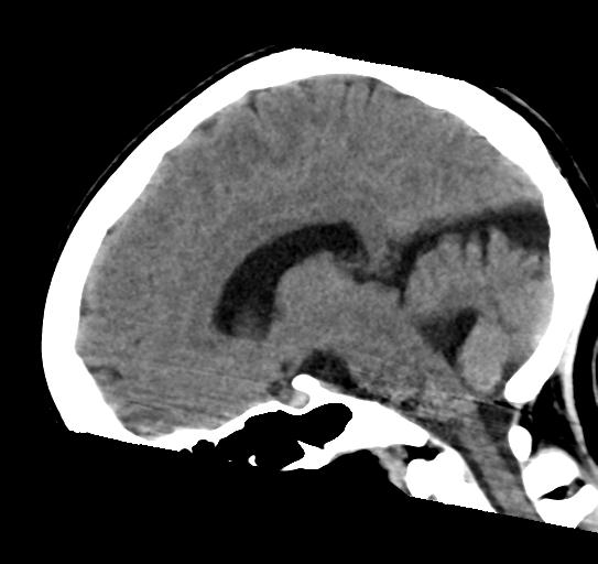 File:Atretic encephalocoele with inferior vermis hypoplasia (Radiopaedia 30443-31107 C 14).jpg