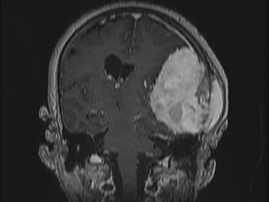 Atypical meningioma (Radiopaedia 62985-71406 Coronal T1 C+ 68).jpg