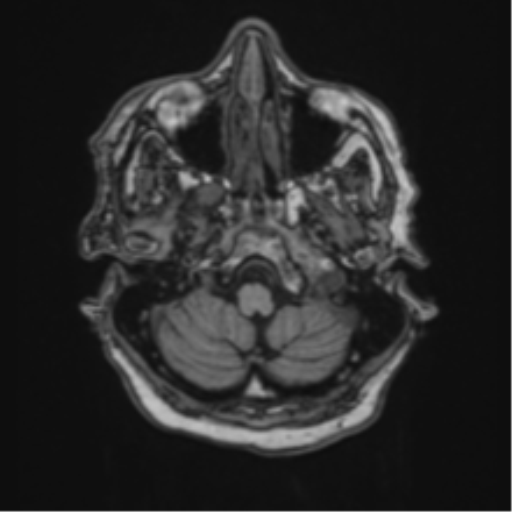 Atypical meningioma (WHO Grade II) (Radiopaedia 54742-60981 Axial T1 10).png