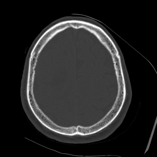 Atypical meningioma with skull invasion (Radiopaedia 34357-35649 Axial bone window 64).png