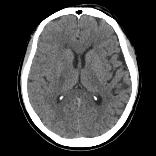 Atypical meningioma with skull invasion (Radiopaedia 34357-35649 Axial non-contrast 29).png