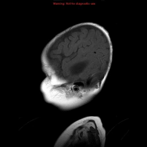File:Atypical teratoid rhabdoid tumor (Radiopaedia 10712-11183 Sagittal T1 3).jpg