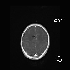 Atypical teratoid rhabdoid tumor (prenatal US and neonatal MRI) (Radiopaedia 59091-66388 Axial T1 C+ 49).jpg