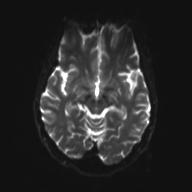 Autoimmune limbic encephalitis (Radiopaedia 30363-31005 Axial B0 and DWI 15).jpg