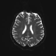 File:Autoimmune limbic encephalitis (Radiopaedia 30363-31005 Axial B0 and DWI 21).jpg