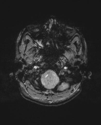 Autoimmune limbic encephalitis (Radiopaedia 30363-31005 SWI - magnitude 8).jpg