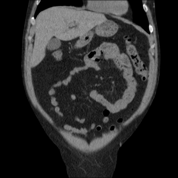 File:Autosomal dominant polycystic kidney disease (Radiopaedia 36539-38101 C 19).jpg
