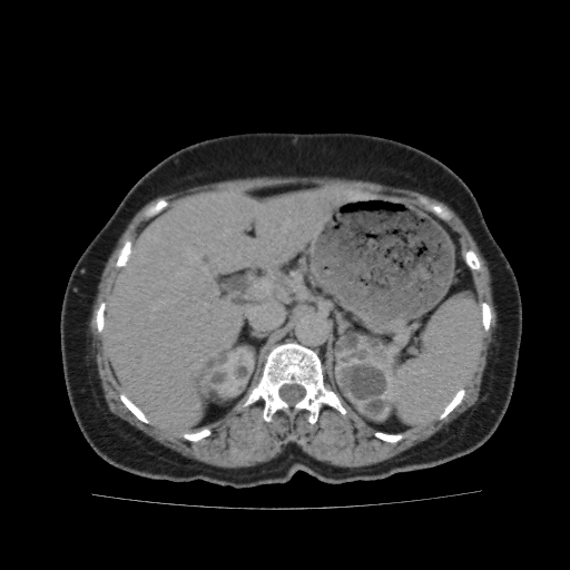 Autosomal dominant polycystic kidney disease (Radiopaedia 38189-40194 Axial C+ delayed 12).jpg