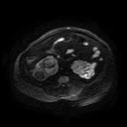 Autosomal dominant polycystic kidney disease (Radiopaedia 50259-55611 Axial DWI 102).jpg