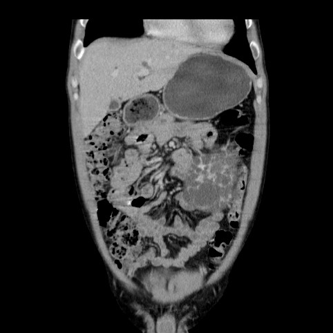 Autosomal dominant polycystic kidney disease (Radiopaedia 66349-75582 A 13).jpg