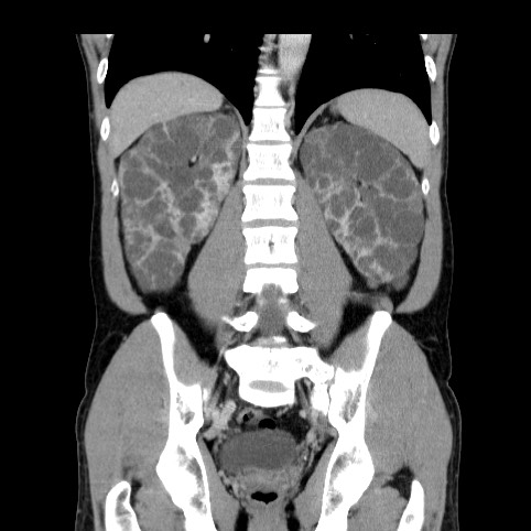 File:Autosomal dominant polycystic kidney disease (Radiopaedia 66349-75582 A 61).jpg