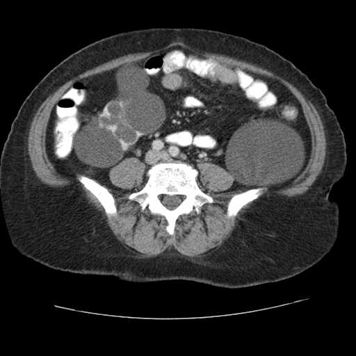 File:Autosomal dominant polycystic kidney disease with hepatic involvement (Radiopaedia 32693-33662 B 53).jpg