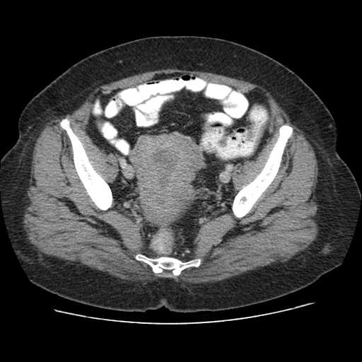 File:Autosomal dominant polycystic kidney disease with hepatic involvement (Radiopaedia 32693-33662 B 69).jpg