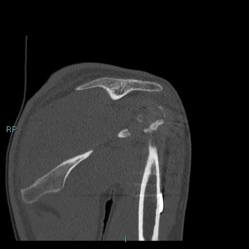 Avascular necrosis after fracture dislocations of the proximal humerus (Radiopaedia 88078-104655 Coronal bone window 59).jpg
