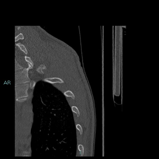 Avascular necrosis after fracture dislocations of the proximal humerus (Radiopaedia 88078-104655 Sagittal bone window 96).jpg