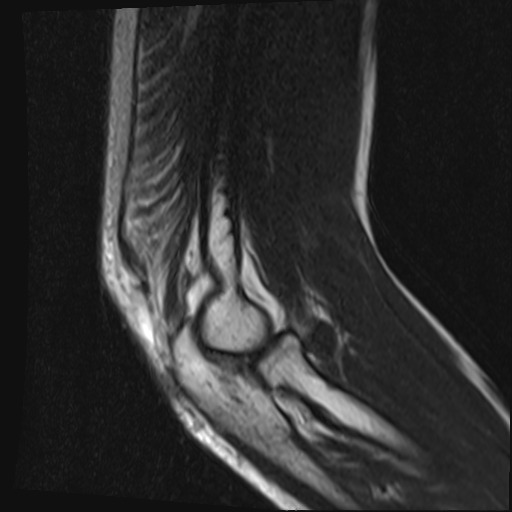 File:Avulsion of the triceps tendon (Radiopaedia 42919-46154 Sagittal T2 1).jpg