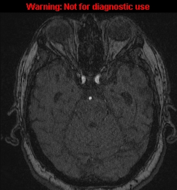 Azygos anterior cerebral artery (Radiopaedia 59325-66677 Axial MRA 54).jpg
