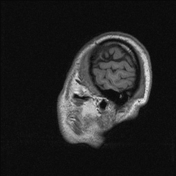 Balo concentric sclerosis (Radiopaedia 50458-55940 Sagittal T1 141).jpg