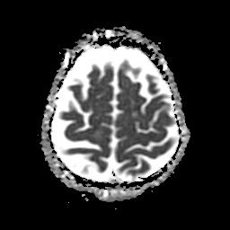 File:Balo concentric sclerosis (Radiopaedia 53875-59982 Axial ADC 21).jpg