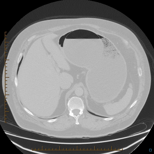 File:Bariatric balloon causing gastric outlet obstruction (Radiopaedia 54449-60672 Axial lung window 1).jpg