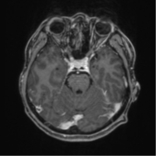 File:Basal ganglia subacute infarct (Radiopaedia 80201-93521 T1 C+ fat sat 18).png
