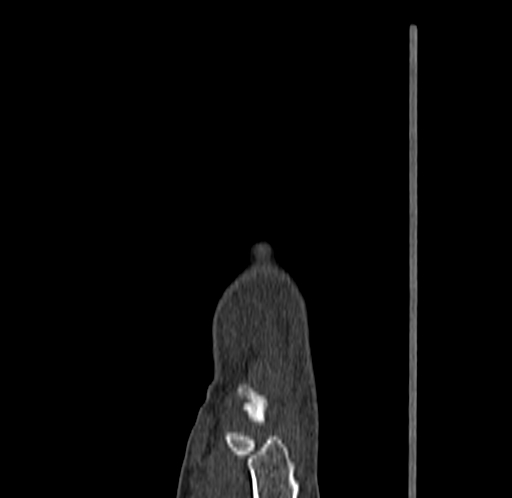 Base of 2nd metacarpal fracture (Radiopaedia 73741-84544 Sagittal bone window 26).jpg