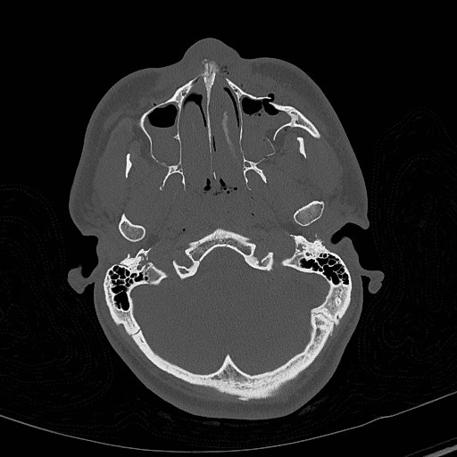 File:Base of skull fracture with bilateral Le Fort fractures (Radiopaedia 47094-51638 Axial bone window 22).jpg
