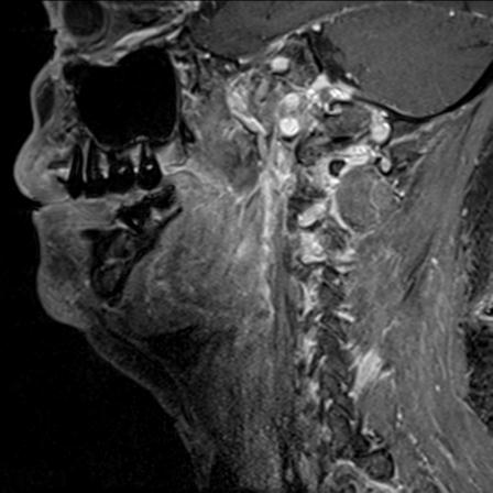 File:Base of tongue squamous cell carcinoma (Radiopaedia 31174-31884 F 118).jpg