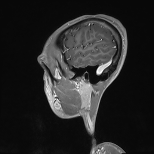 Basilar artery perforator aneurysm (Radiopaedia 82455-97733 G 128).jpg