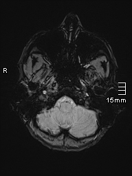 Basilar artery perforator aneurysm (Radiopaedia 82455-99523 Axial SWI 7).jpg