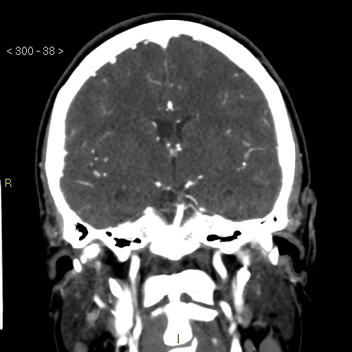 File:Basilar artery thrombosis (Radiopaedia 16260-15944 B 29).jpg
