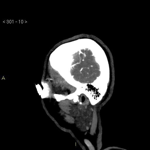 Basilar artery thrombosis (Radiopaedia 16260-15944 C 4).jpg