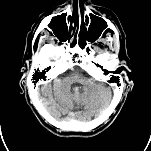 File:Basilar artery thrombosis (Radiopaedia 26986-27162 Axial non-contrast 8).jpg